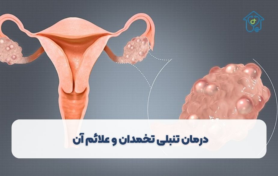 درمان تنبلی تخمدان