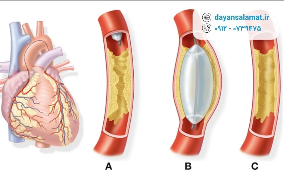 آنژیو قلب چیست و مراحل انجام آن به چه صورت است؟